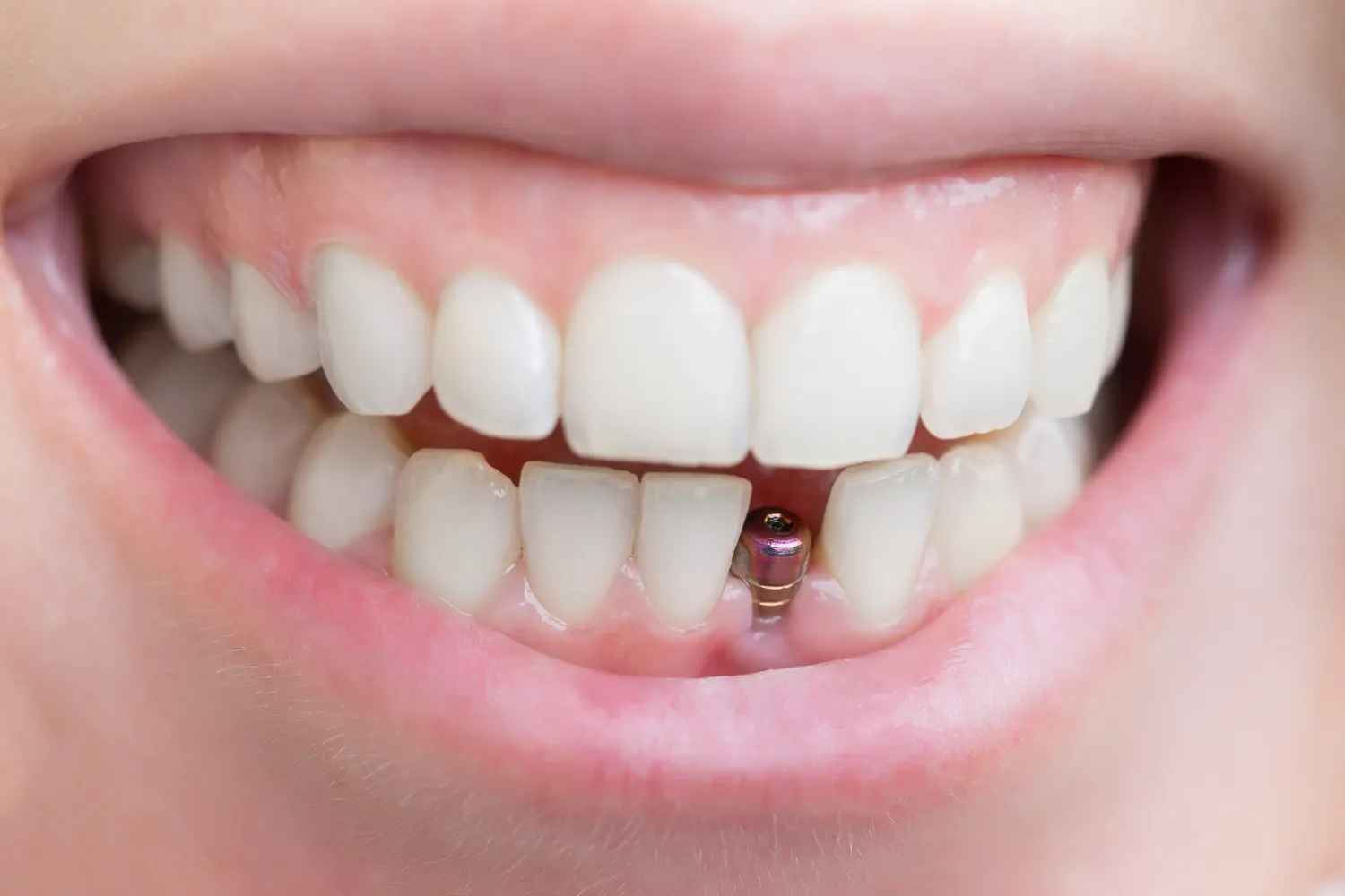 Implanty dentystyczne Szczecin