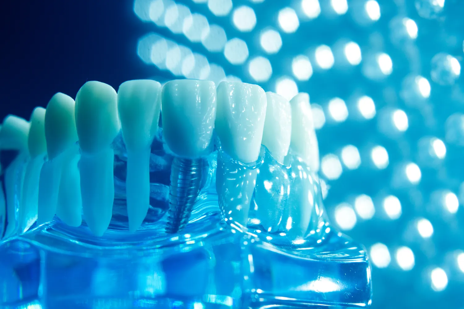 Implanty zębowe Szczecin cena