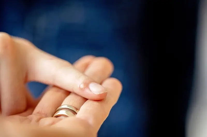 Co najlepiej na kurzajki?